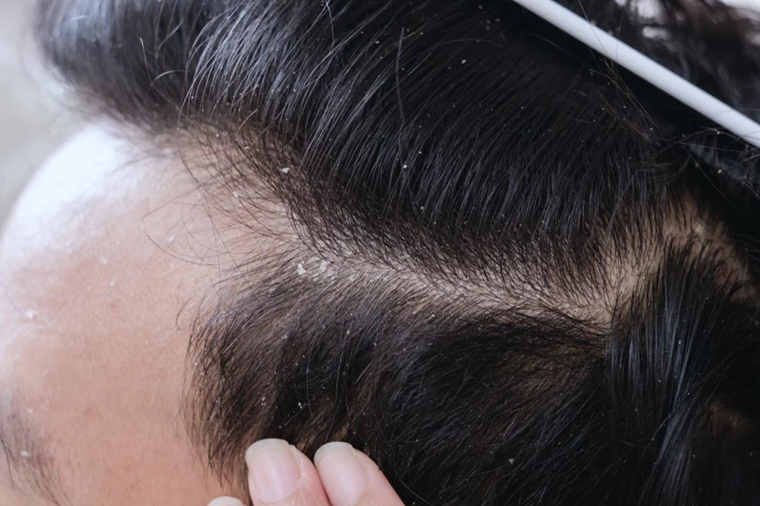 Young man with problem of dandruff receiving injection on light background, closeup